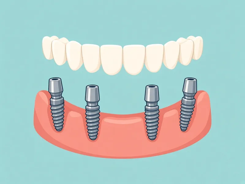 Cartoon diagram of a full arch of teeth above four implant posts in the jaw