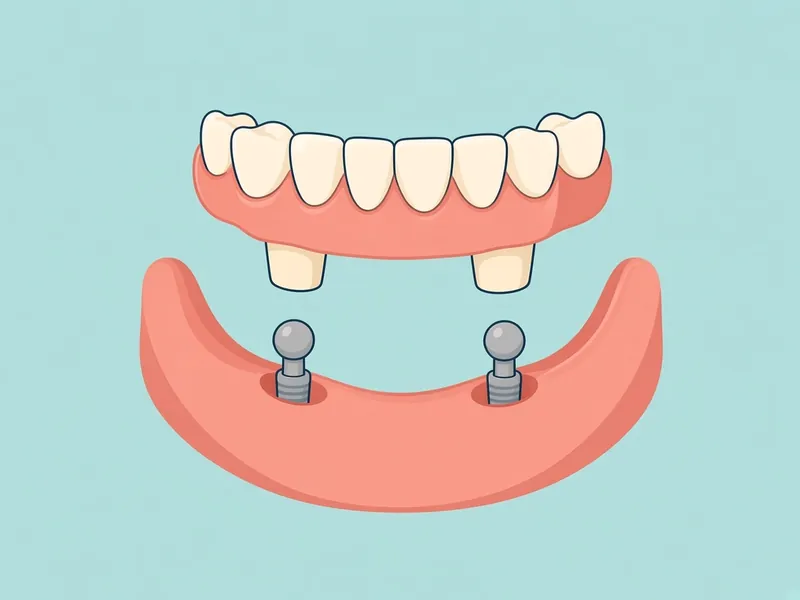 Cartoon diagram of a removable denture above two implant posts with snap attachments